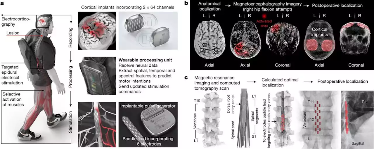 Experimental brain-spine interface helps paralyzed man walk