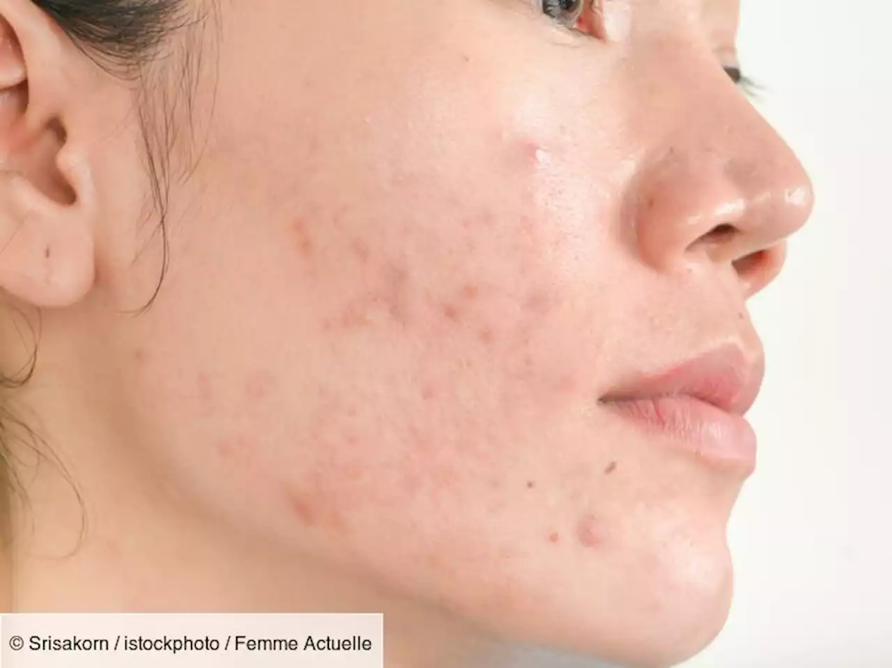 Acné à la ménopause : voici trois conseils pour l’atténuer, selon des dermatologues