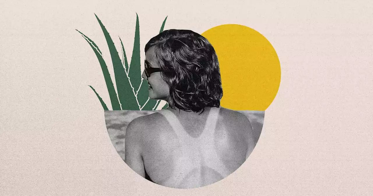 Suburnt? Get relief with these 7 home remedies