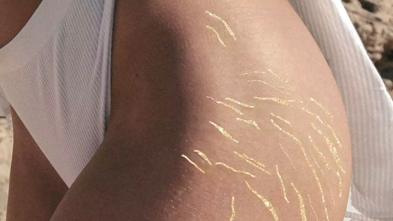 Stretch marks and everything you need to know, whether you like or loathe your stripes