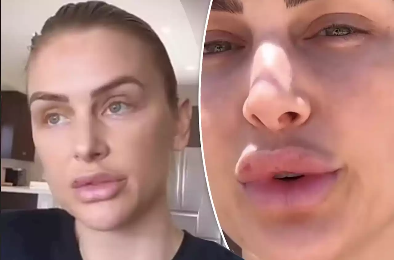 Lala Kent defends ‘bruised’ pout after lip filler: ‘I don’t care’ what you think