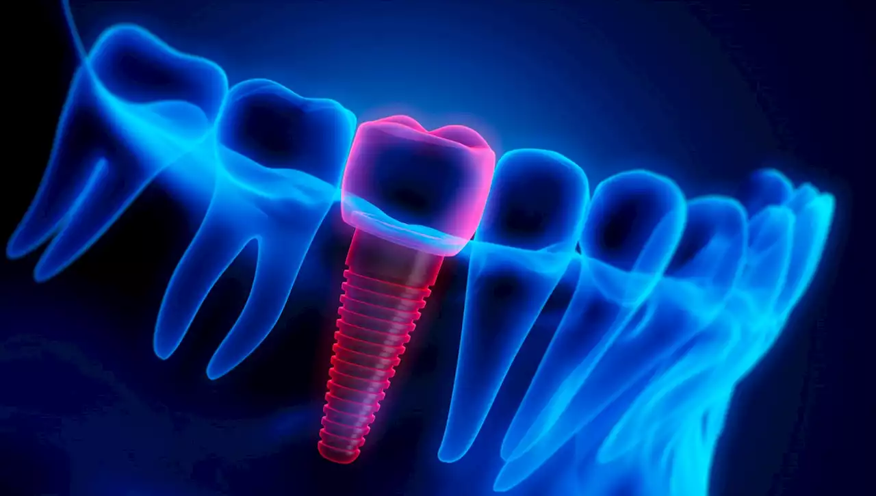 AI in dentistry: Researchers find that artificial intelligence can create better dental crowns