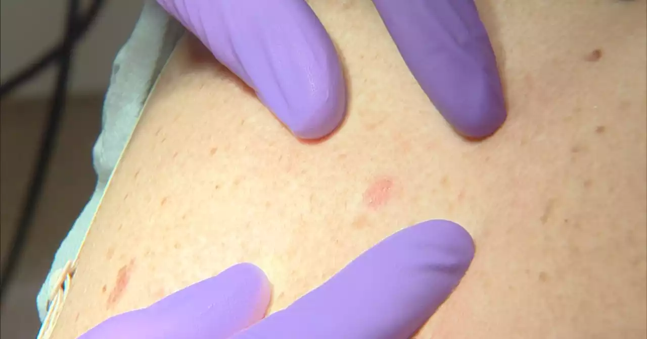 Doctors, survivors offer potential life-saving advice on melanoma