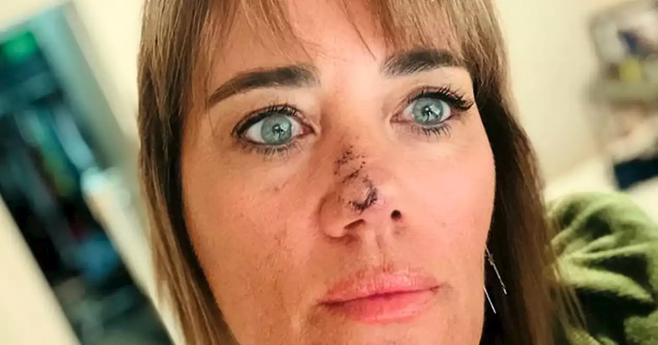 Woman diagnosed with skin cancer after covering pimple on nose for months