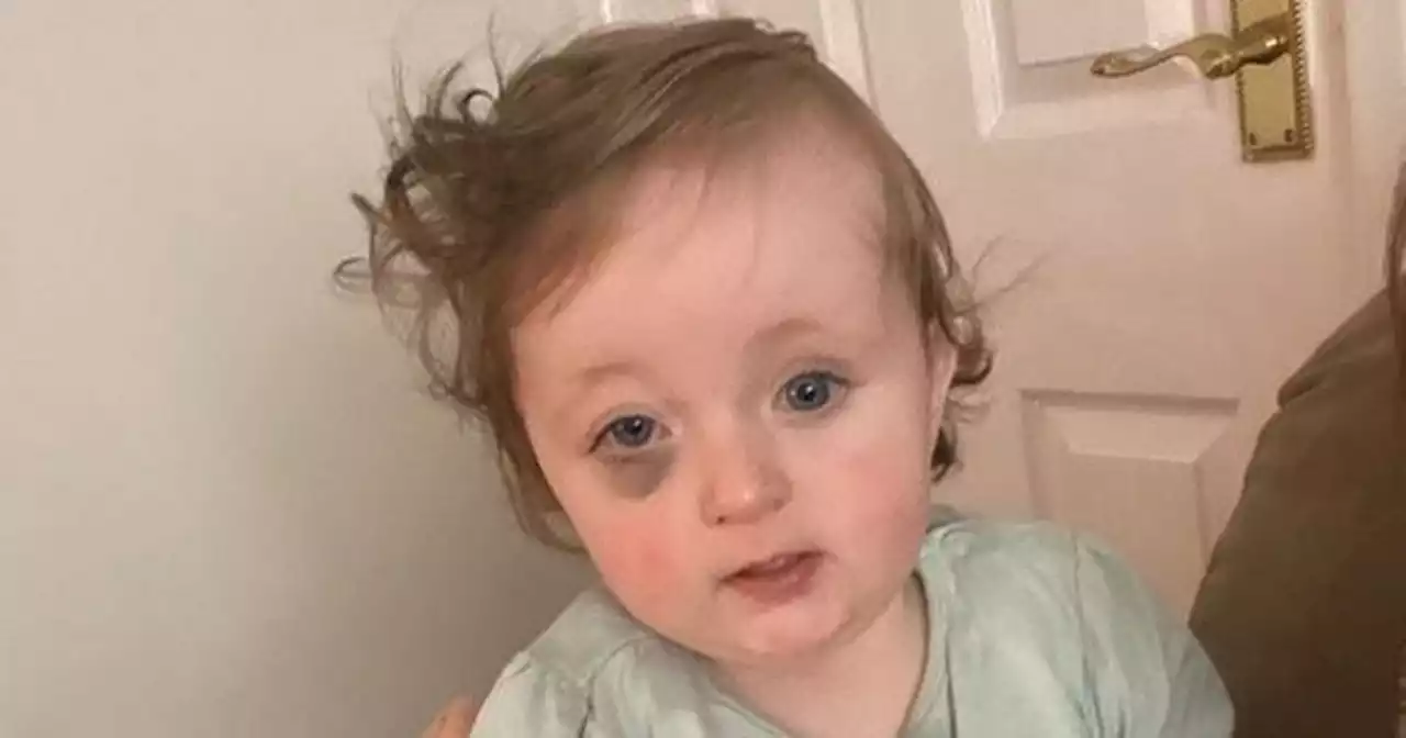 Couple who noticed bruise on baby's eye receive devastating diagnosis