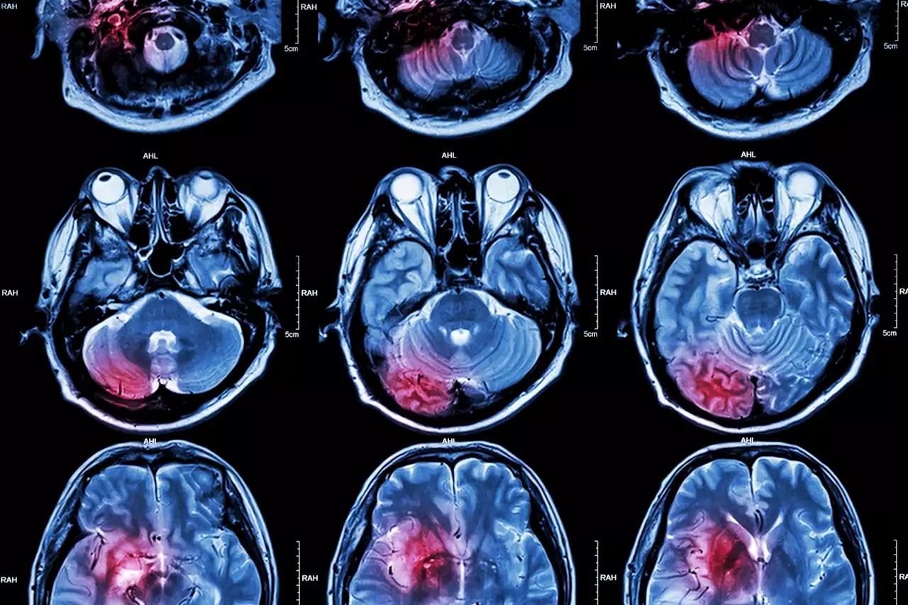 Could implementing a goal-directed care bundle for lowering blood pressure improve outcomes for patients with intracerebral hemorrhage?