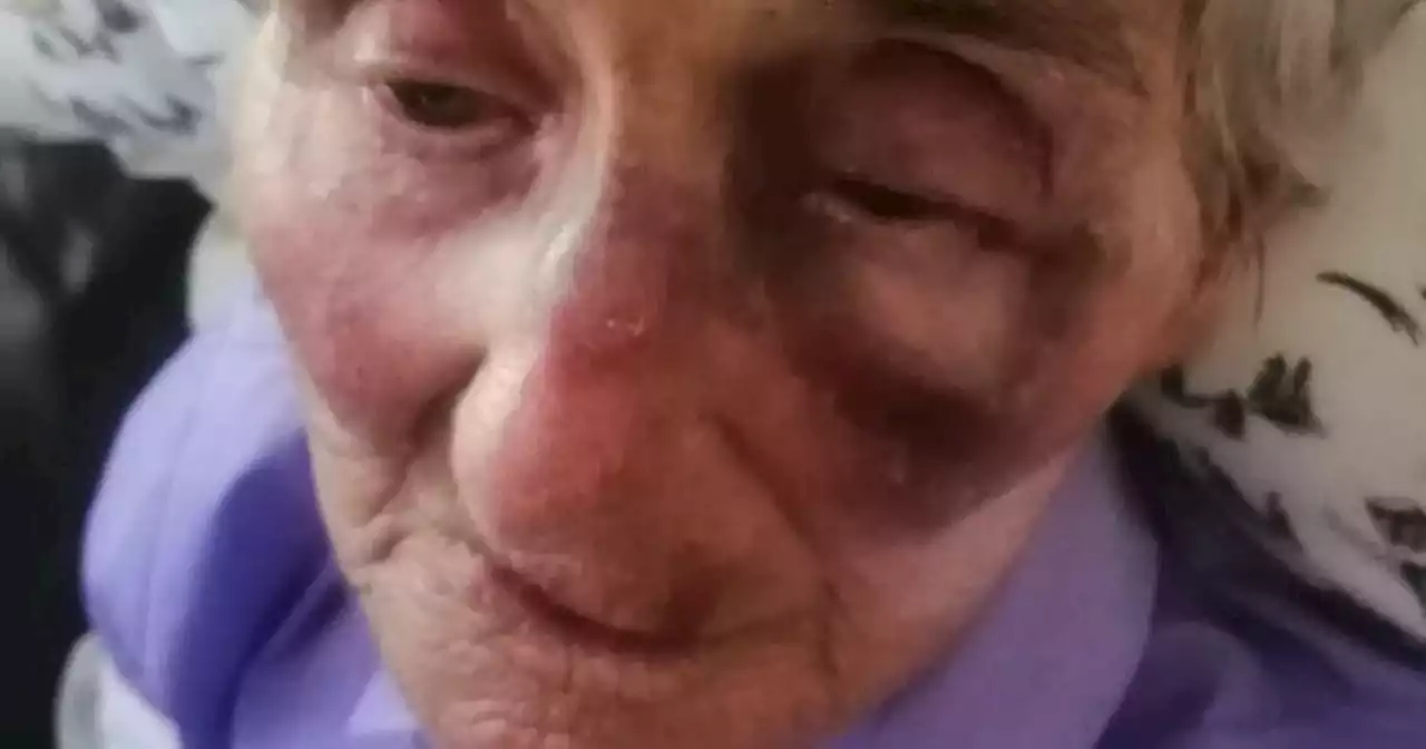 Water balloons thrown at car leaves lady aged 95 with severe eye injury