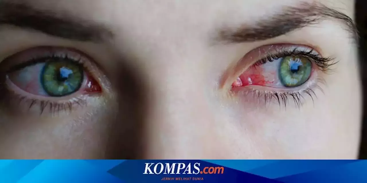 Kenali Apa Itu Konjungtivitis Pada Varian Covid Arcturus