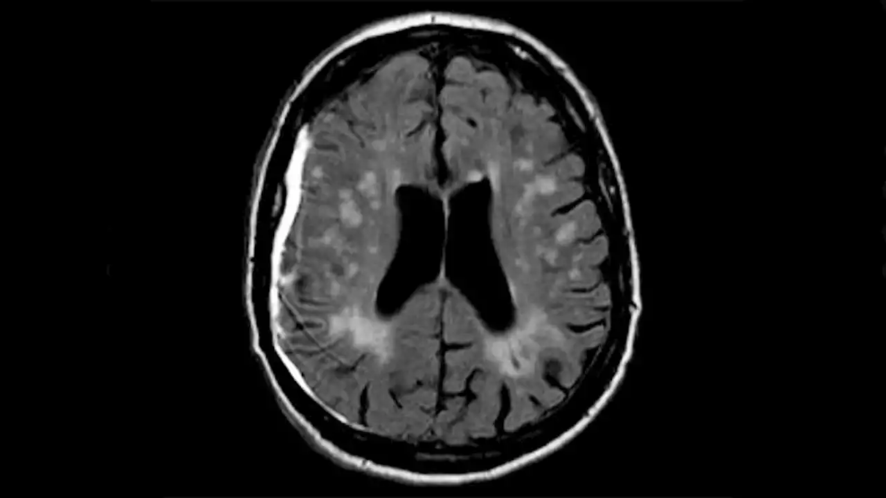 Similar Result for Craniotomy, Craniectomy in Acute Hematoma