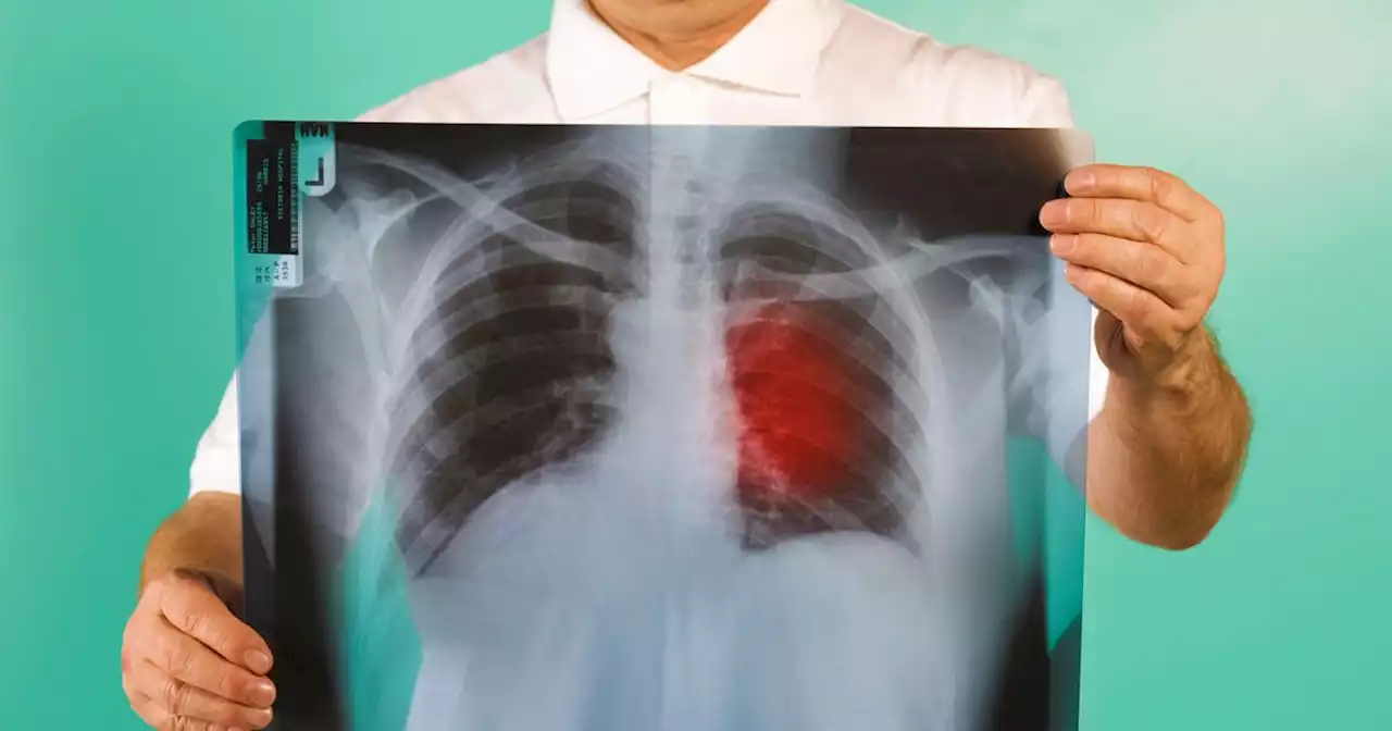 Lung cancer warning as people urged to try 'finger test' to identify disease