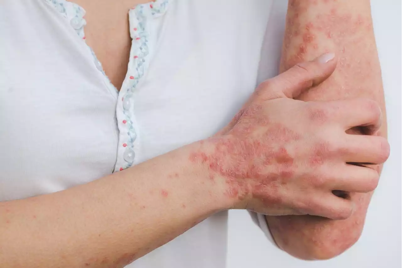 Psoriasis : ces 4 aliments à éviter