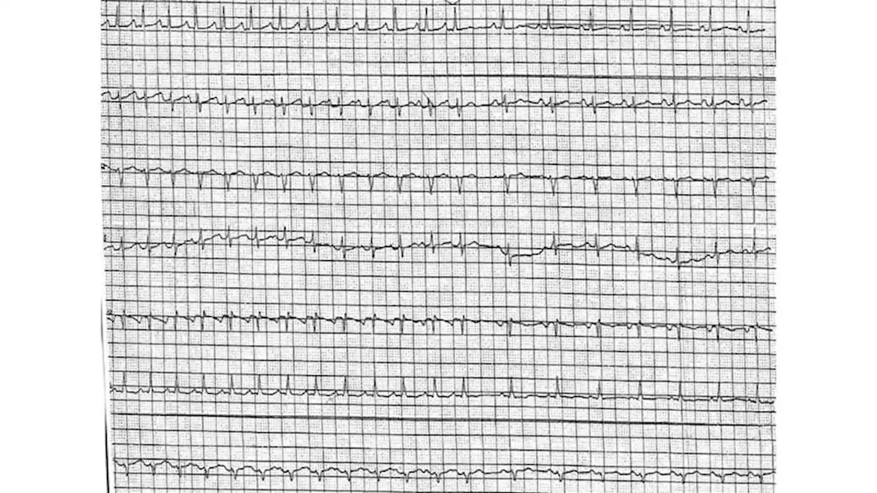 ECG Challenge: Mid-Sternal Pain With Exercise