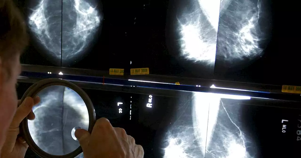 Health panel that sparked mammogram controversy now says tests should start at 40