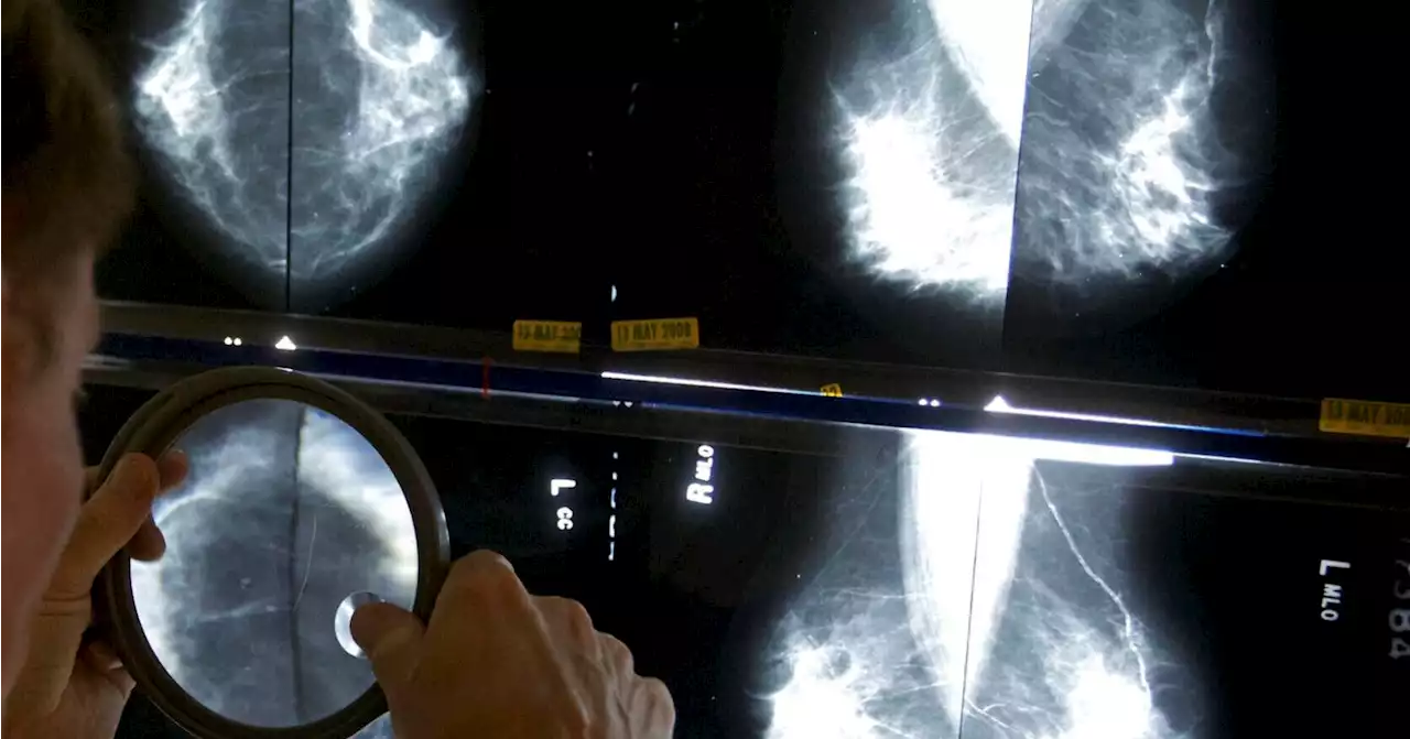 Women should start screening for breast cancer at age 40 instead of 50, health task force says in draft recommendation