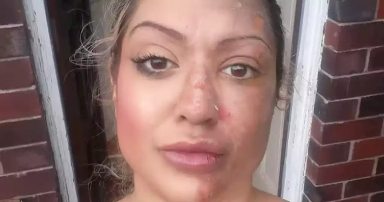 Mum in 'absolute agony' after suffering burns in viral TikTok trend