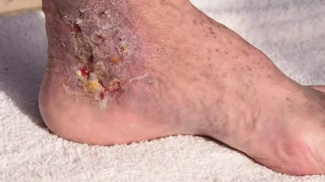 Fast Five Quiz: Cellulitis