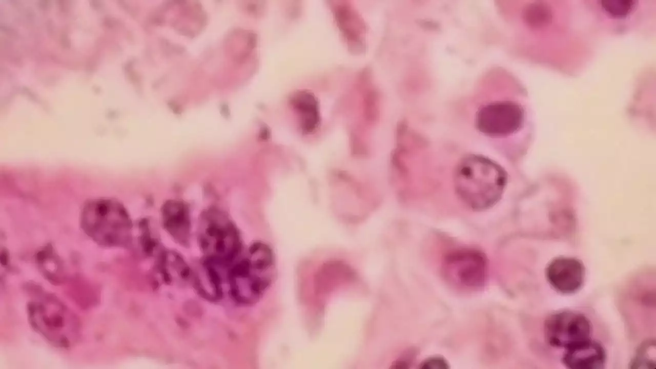 North Texas child diagnosed with measles, state's first case since 2019