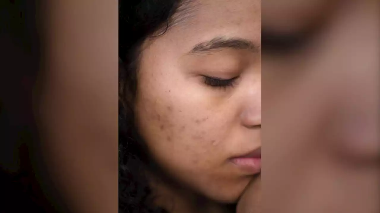 Skin flare-ups? Here might be why acne is coming back: expert