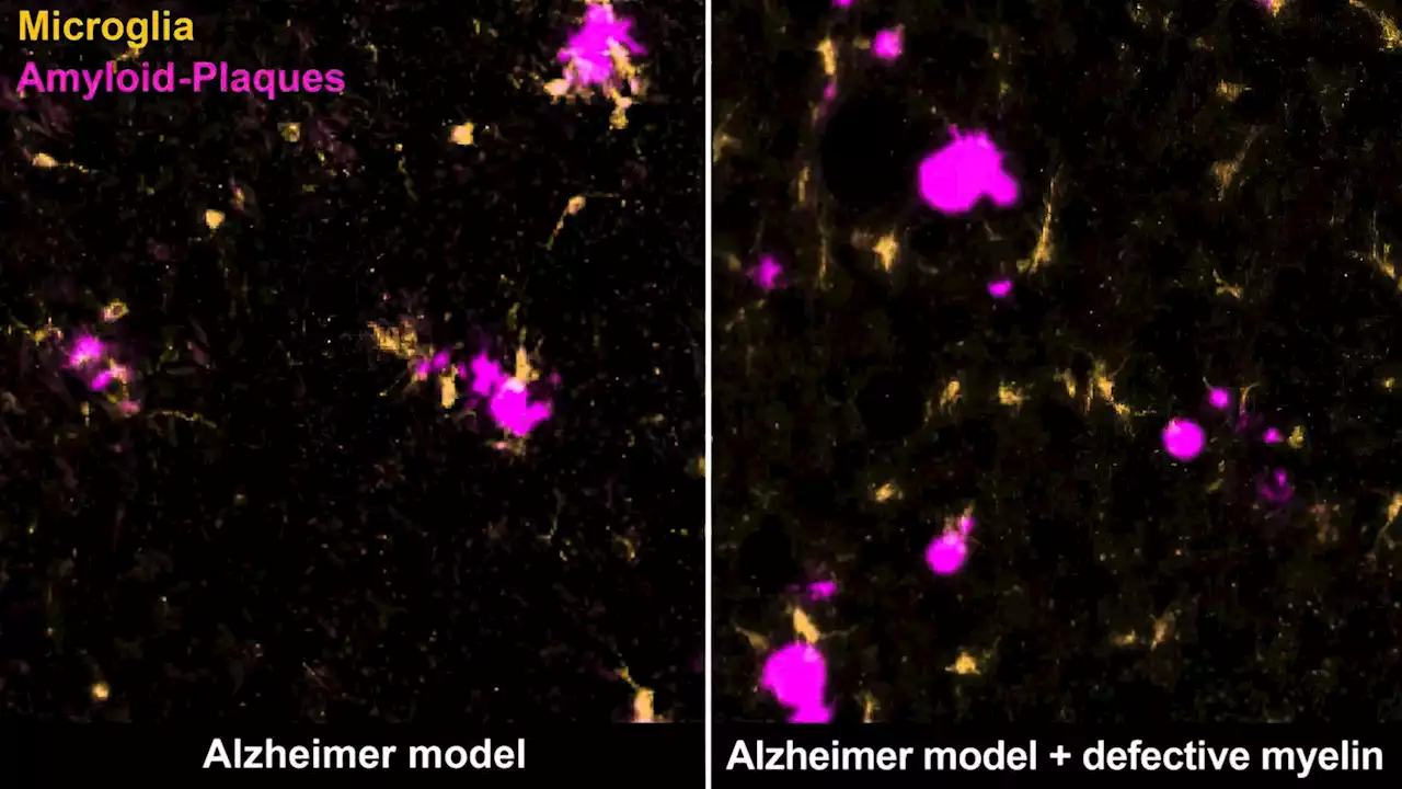 New Hope in Alzheimer’s Fight: Addressing Myelin Degradation Could Prevent Disease