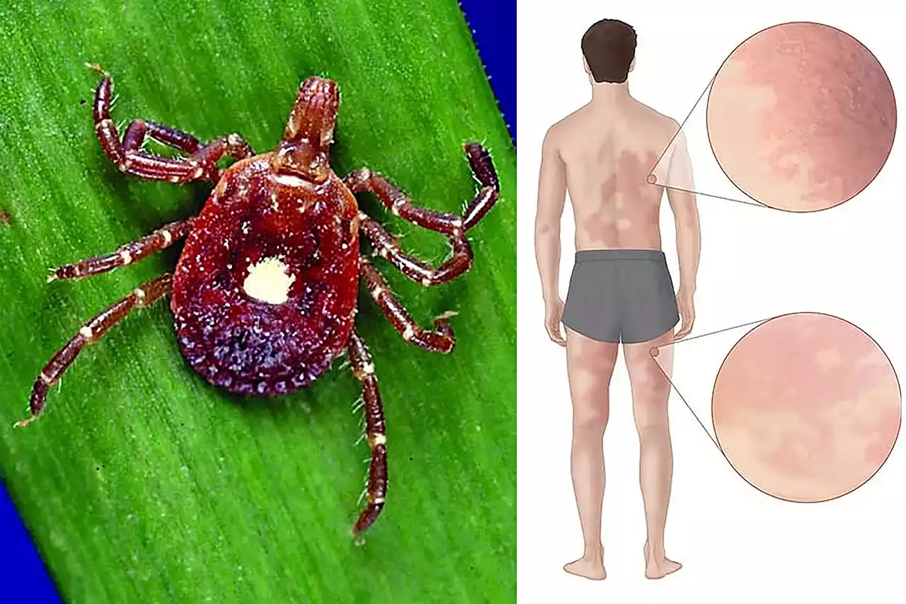 Incurable meat allergy from tick bite ‘turned my life upside down’: NJ man