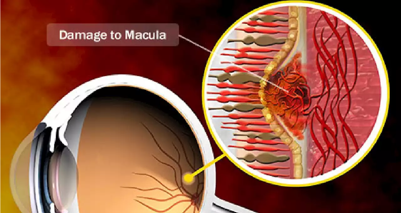 Age-Related Macular Degeneration