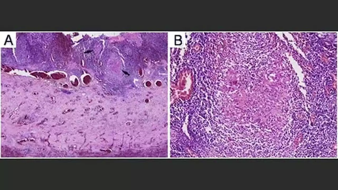 5 Things to Know About CIDP