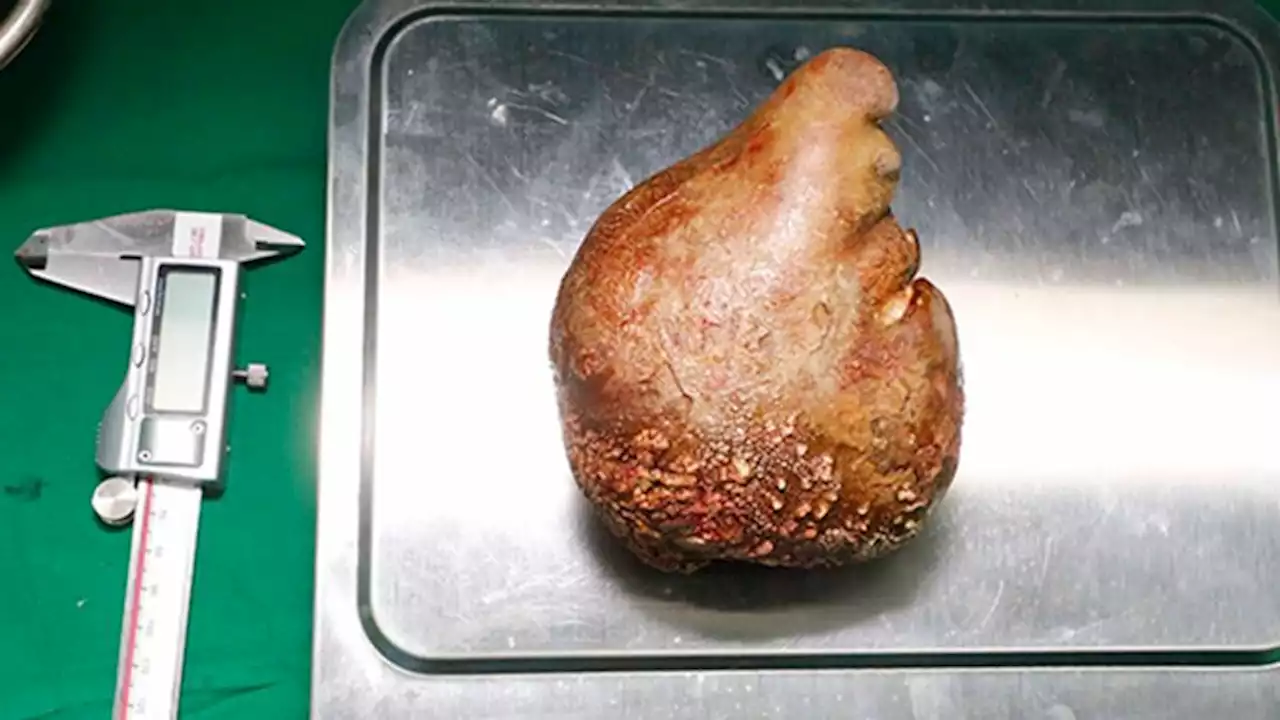 World's largest kidney stone removed -- and it's the size of a grapefruit | CNN