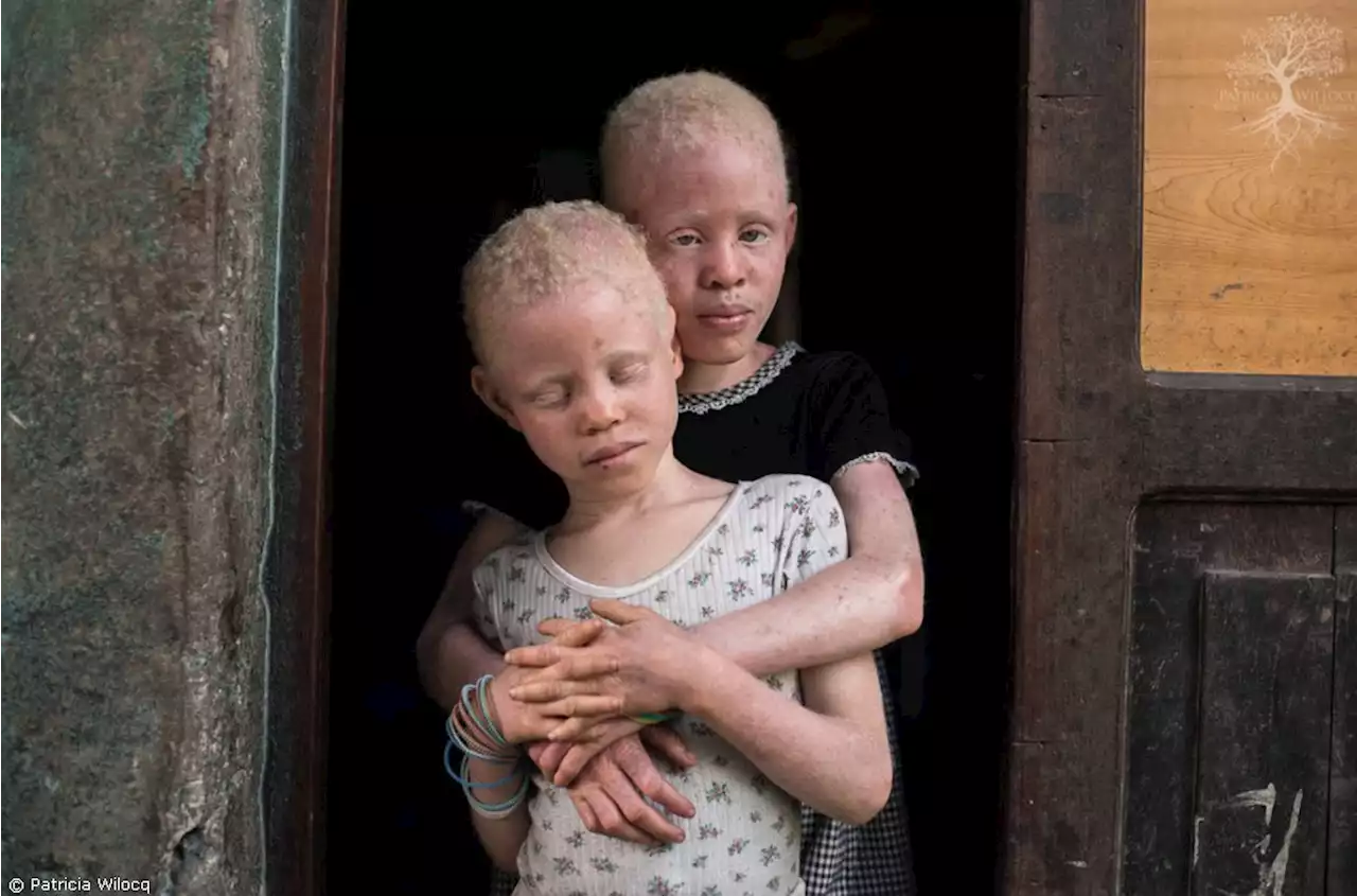 Group to Soludo: Allow students with albinism to wear caps in schools | TheCable