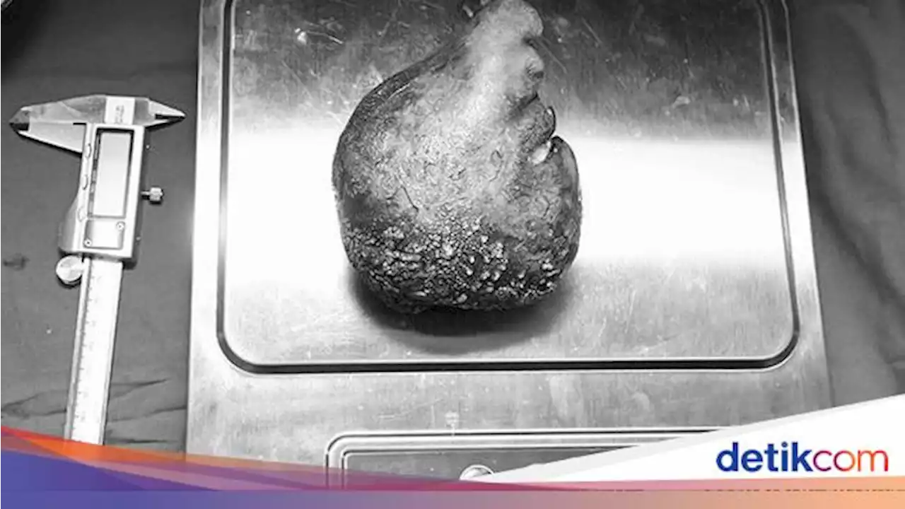 Geger Batu Ginjal Terbesar di Dunia, Ini Gejala yang Dikeluhkan Pengidapnya