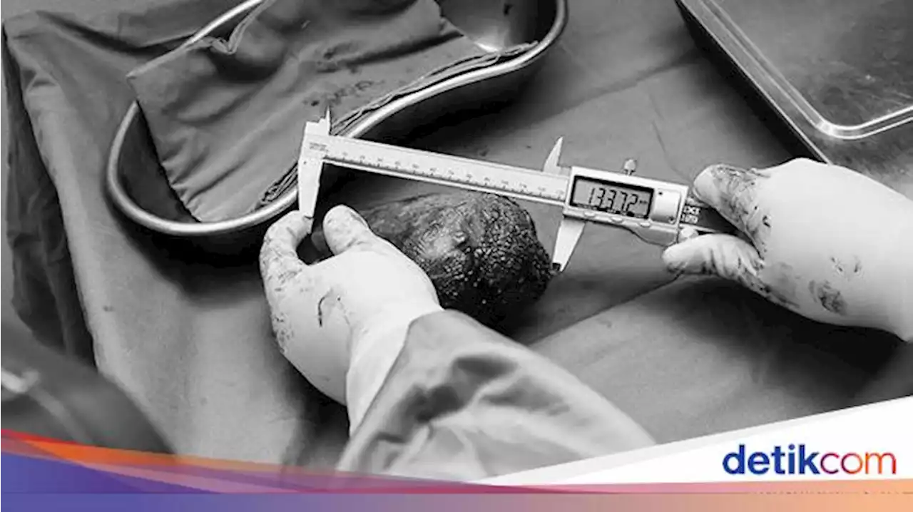 Ini Pemilik Batu Ginjal Terbesar di Dunia, Beratnya 801 Gram