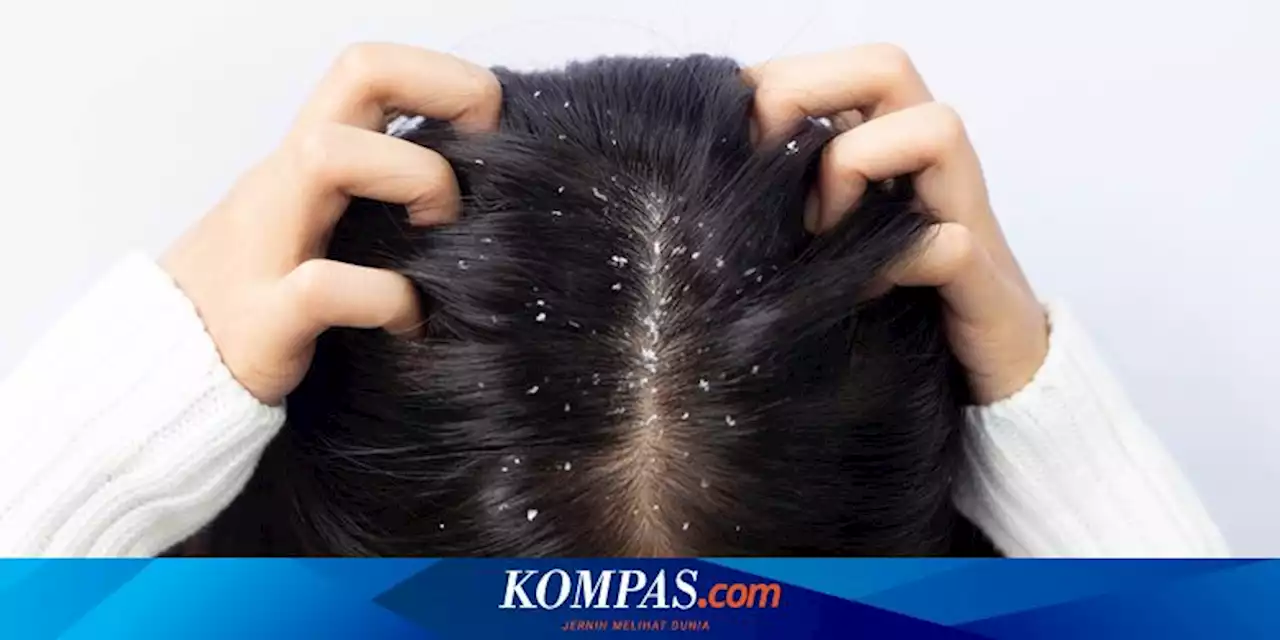 6 Penyebab Timbul Ketombe dan Cara Mengatasinya