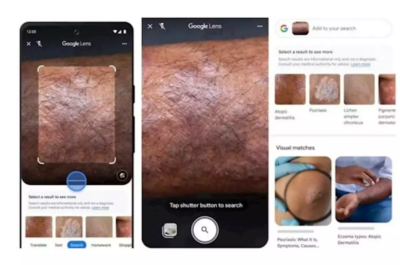 Google Lens Mampu Identifikasi Kondisi Kulit