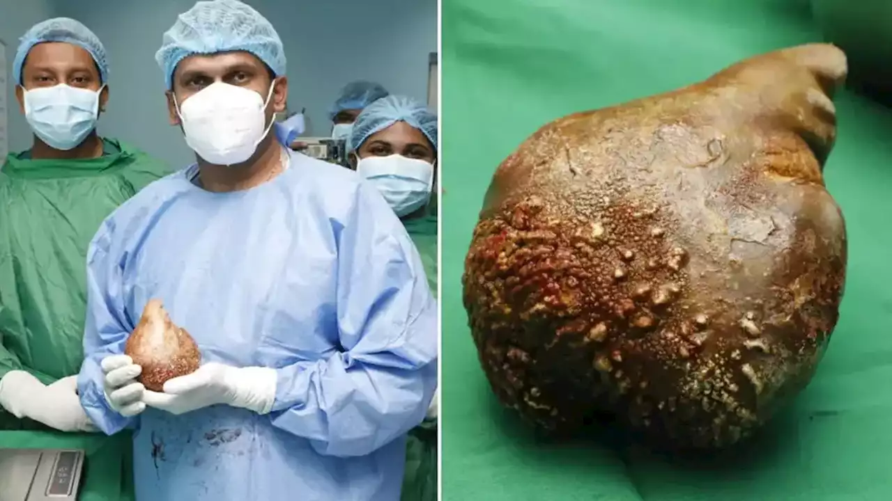 Sri Lankan doctors remove world's largest and heaviest kidney stone