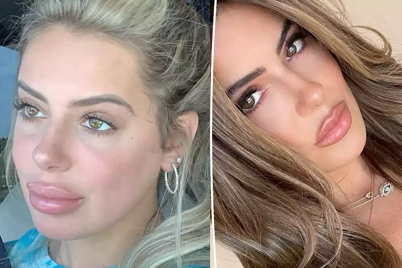 Brielle Biermann warns against getting lips ‘overfilled’ with shocking before-and-after photos