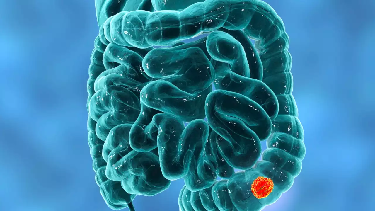 Colon cancer cases increasing among adults under 50