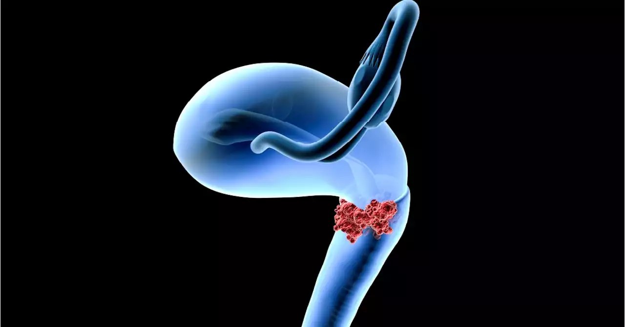 Simple Hysterectomy May Be Better Option for Cervical Cancer