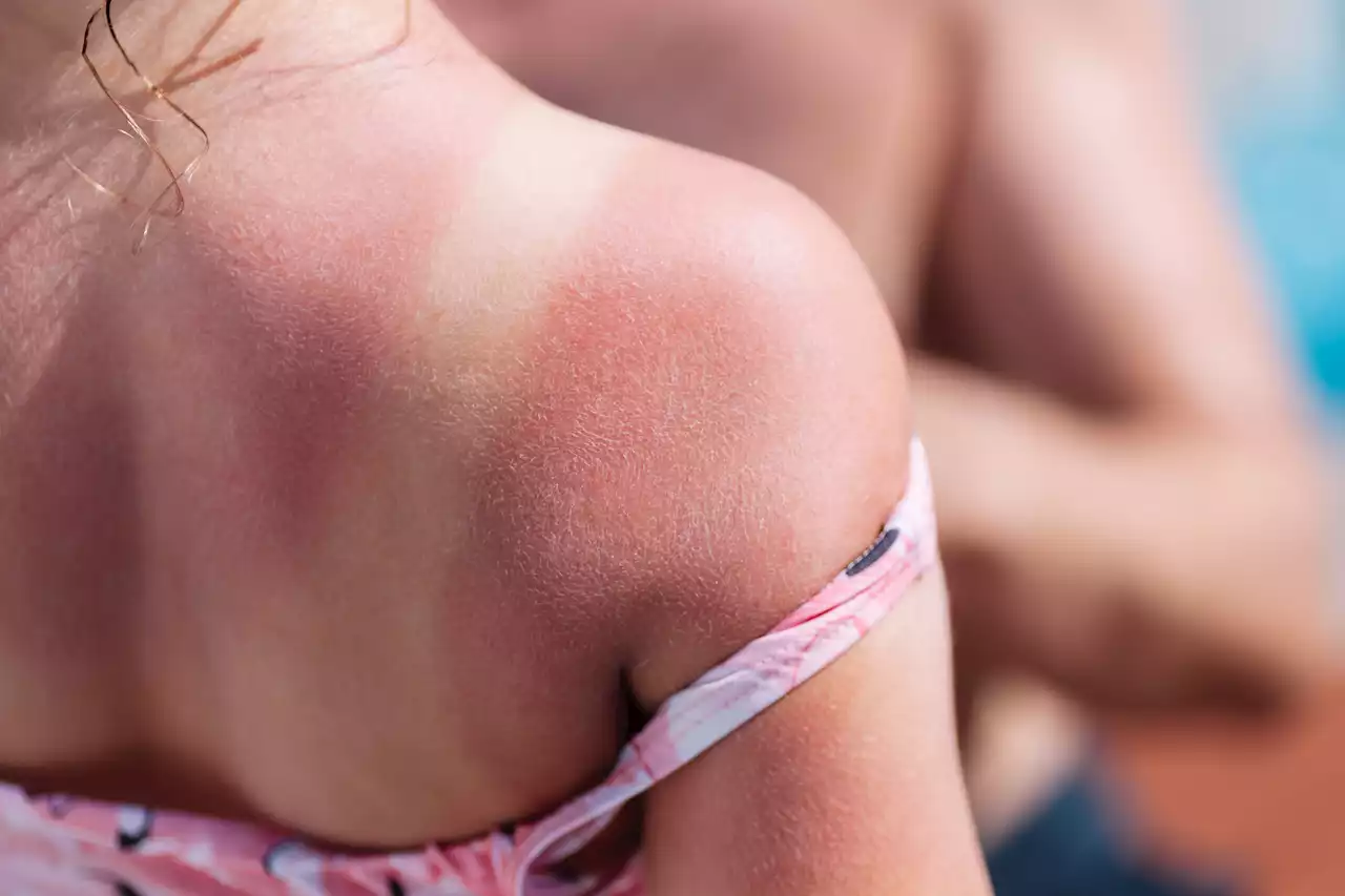 I'm a dermatologist - here's how a common kitchen ingredient can soothe sunburn