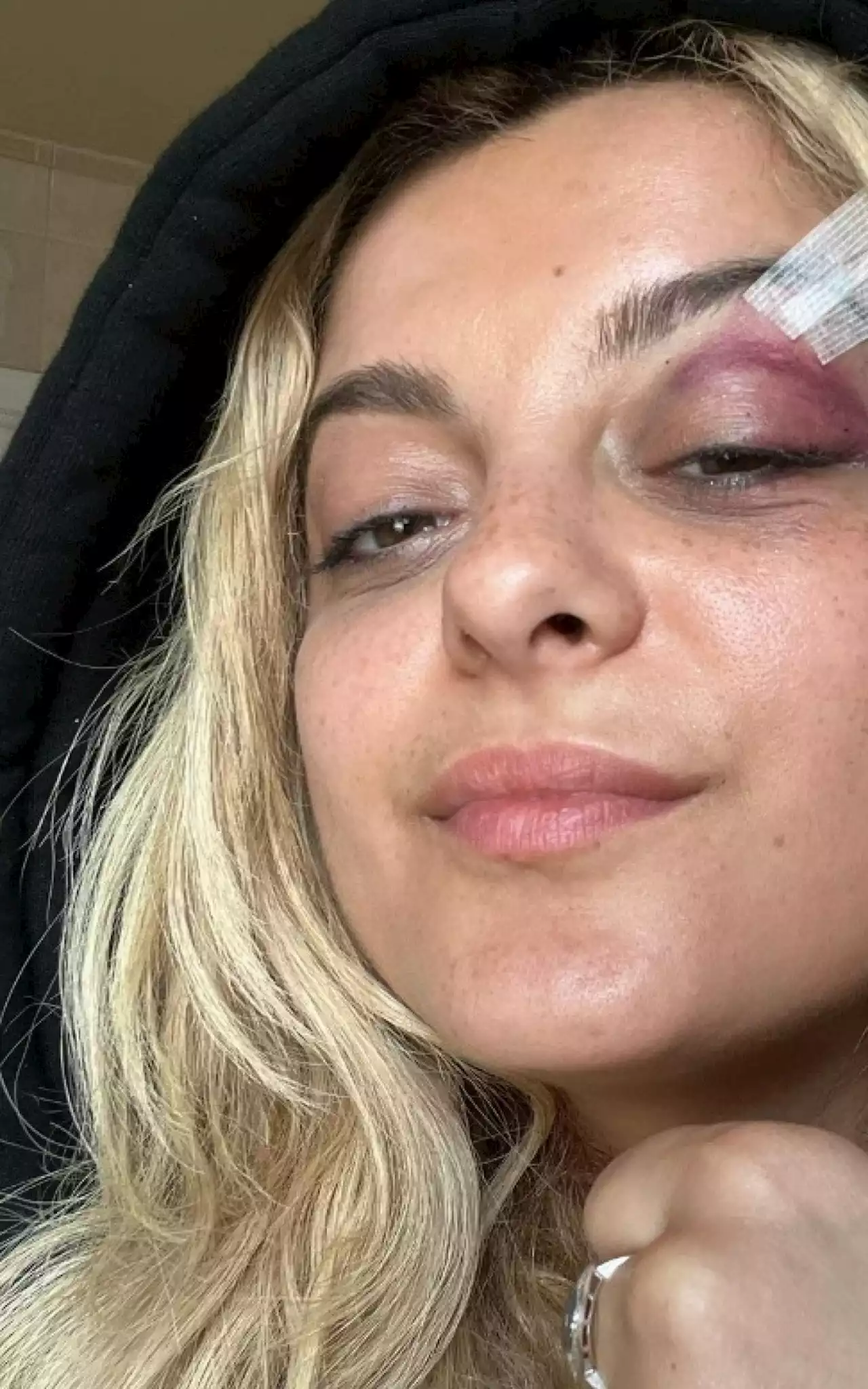 Bebe Rexha exibe hematomas nos rosto após ser atingida por celular em show | Celebridades | O Dia