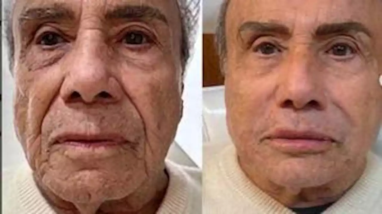 Como Stenio Garcia: veja famosos com mais de 60 anos que fizeram harmonização facial