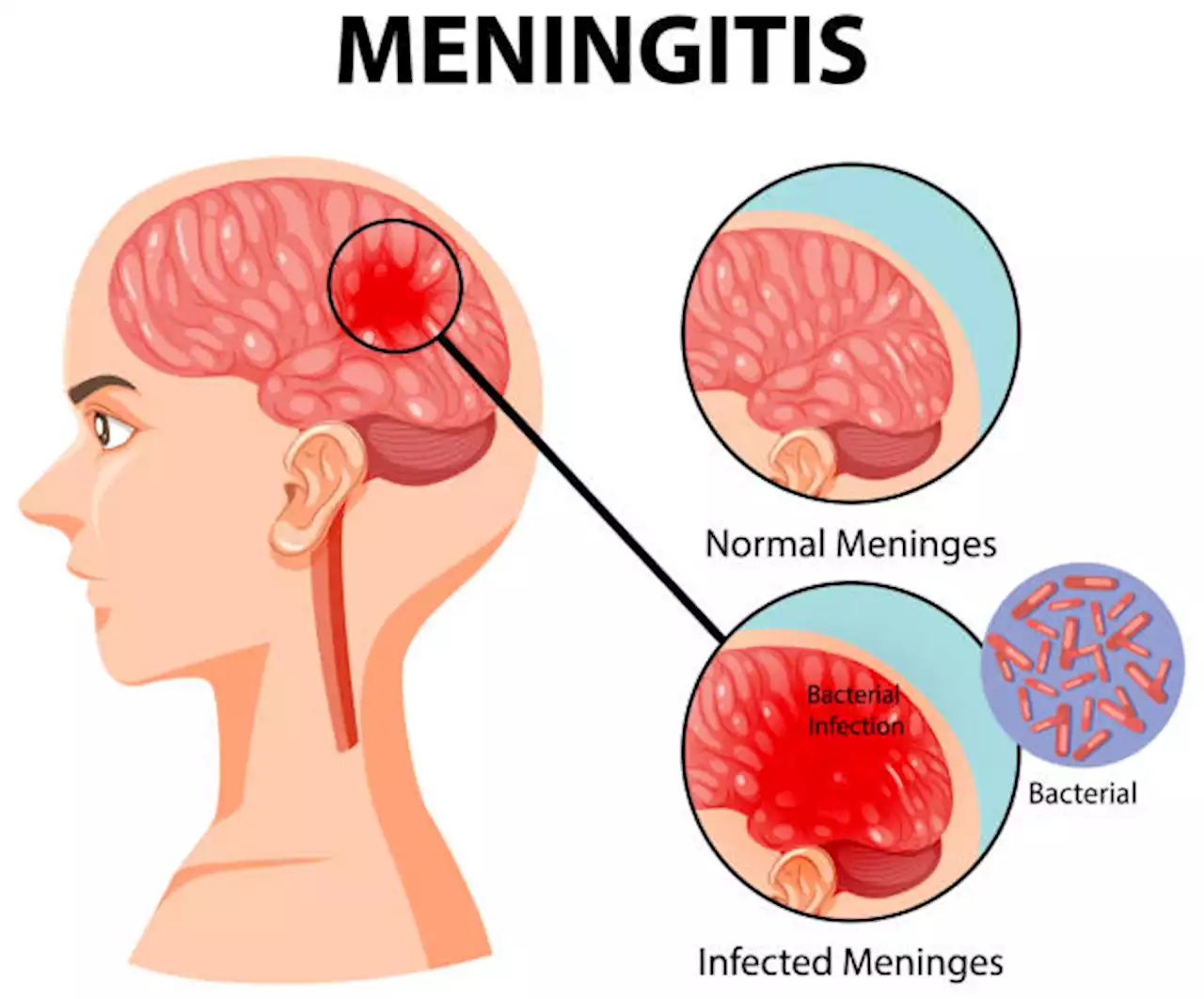 Amor Ring Acintya! Pasien RSUD Meninggal Diduga Akibat Meningitis, Gejala Klinis Mirip Radang Selaput Otak