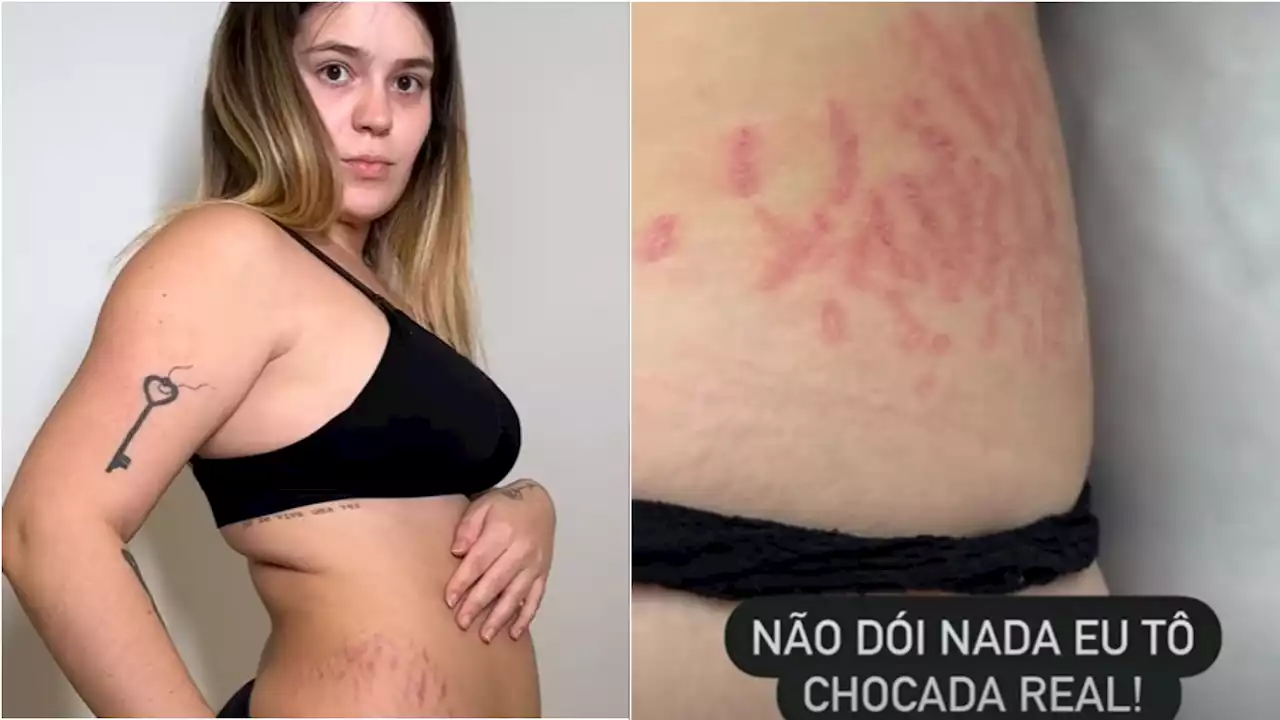 Viih Tube investe em tratamento para estrias; conheça outras opções e métodos de prevenção da condição