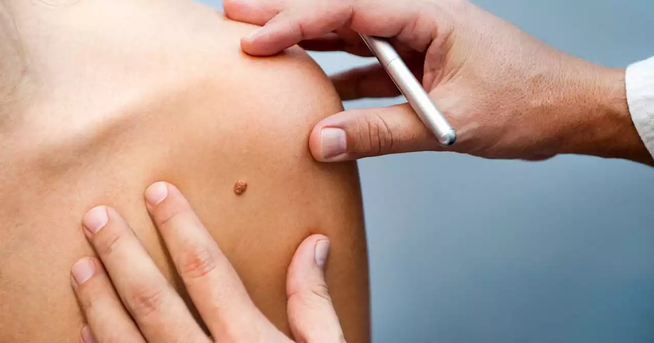 Five skin cancer 'red flag' signs and how to spot them before it's too late