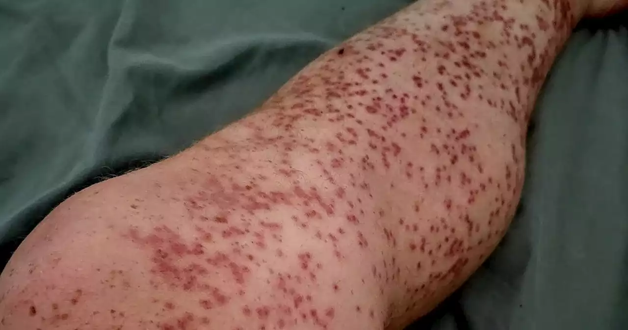 Scots camper covered in hundreds of 'brutal' midge bites as he issues warning