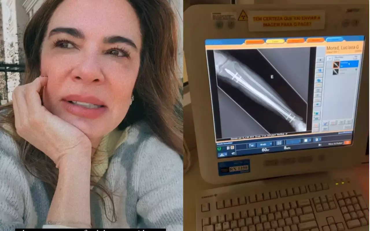 Luciana Gimenez realiza exame e se surpreende com recuperação da perna | Celebridades | O Dia