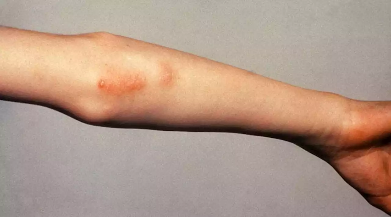 Systemic JIA and AOSD Are the Same Disease, EULAR Says