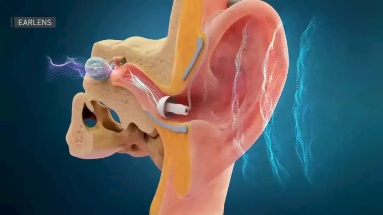 Doctors call high-tech hearing aid developed in Menlo Park a ‘game-changer'