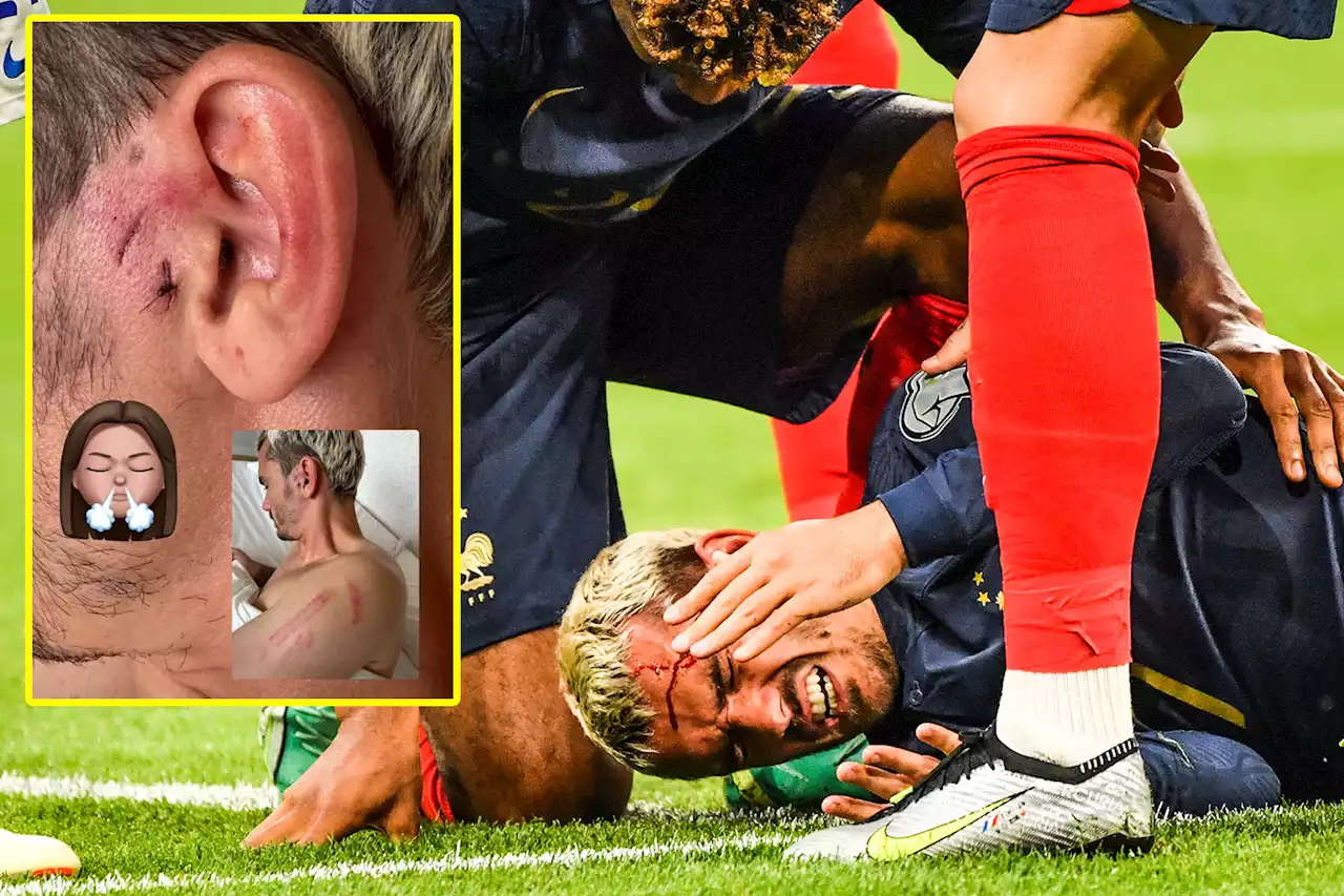 Griezmann shows of gruesome injury after being kicked in the head