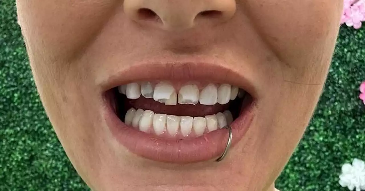 Mum's nightmare after botched veneers left her housebound for THREE YEARS