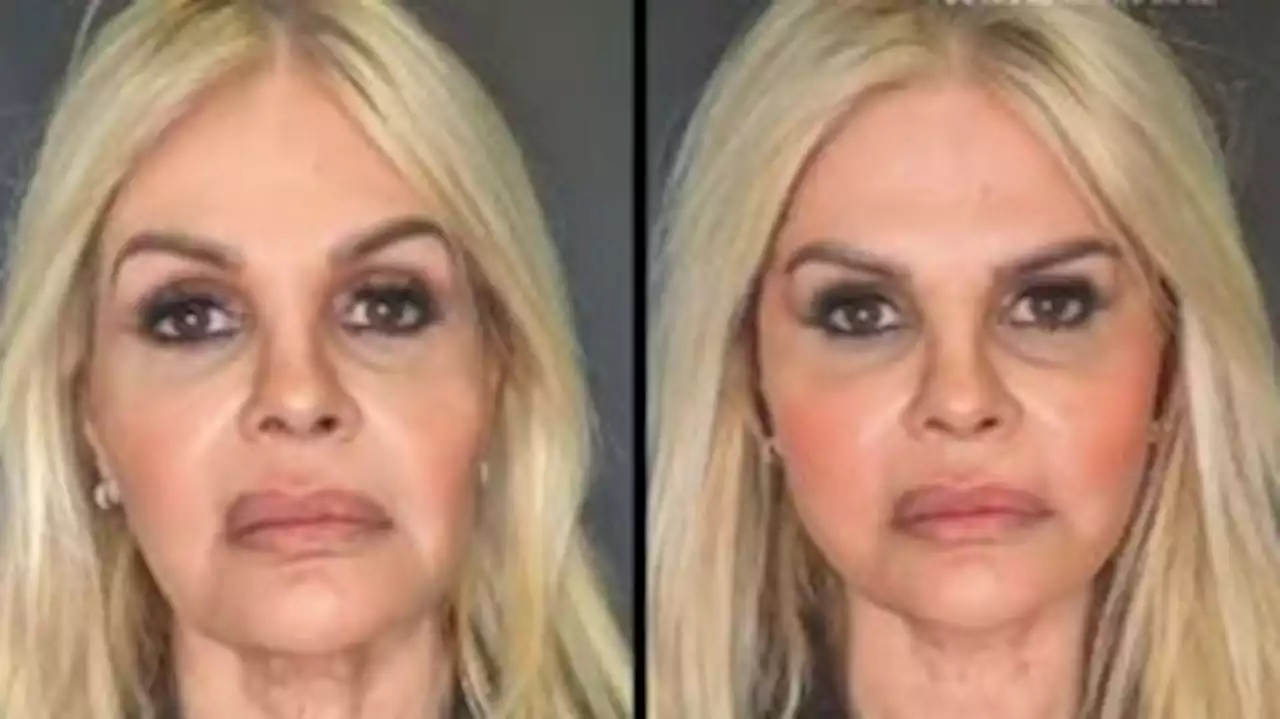 Monique Evans mostra o antes e o depois da harmonização facial: 'Esticou tudo!'