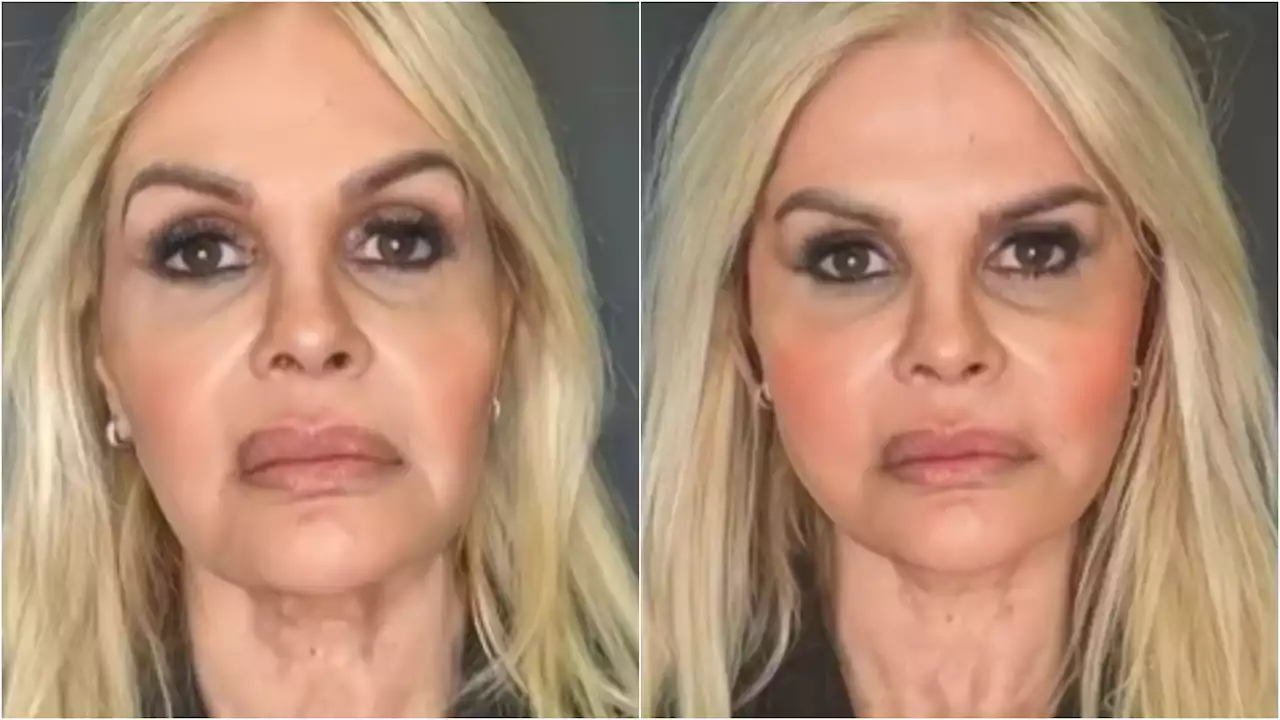 Monique Evans apresenta antes e depois da harmonização facial e resultado surpreende: ‘Feliz’